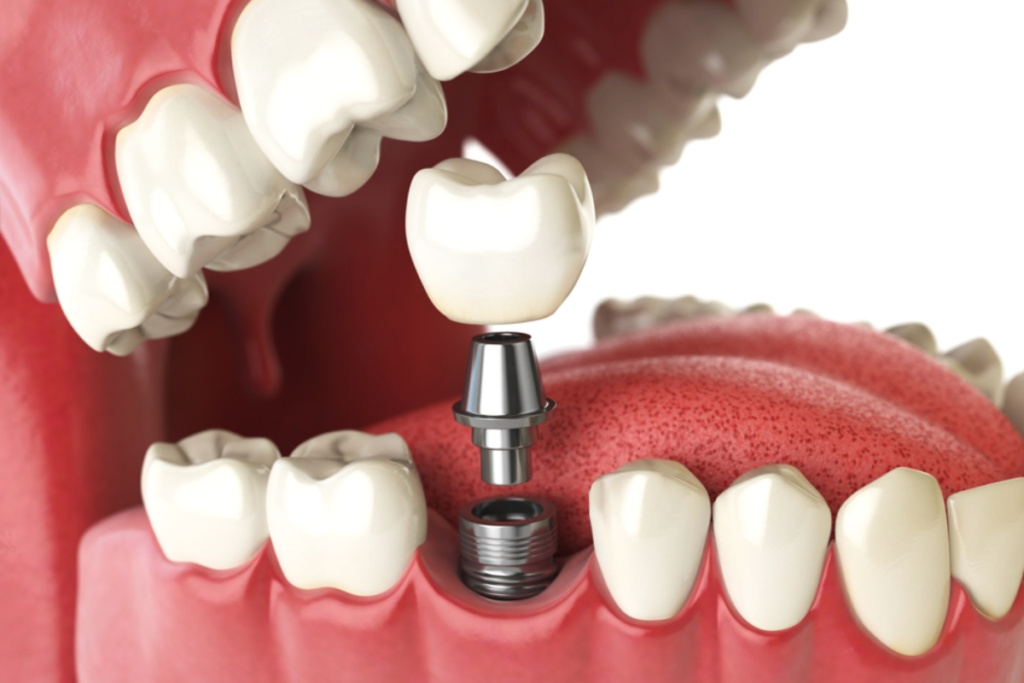 MK Dental Implants
